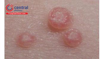 Bệnh hột xoài: nguyên nhân, chẩn đoán và cách điều trị