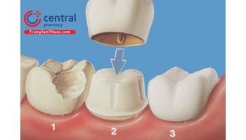 Bọc răng sứ chi phí bao nhiêu có đau không? 5 hậu quả bọc răng sứ