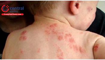 Cách xử lý và phòng tránh dị ứng do côn trùng đốt