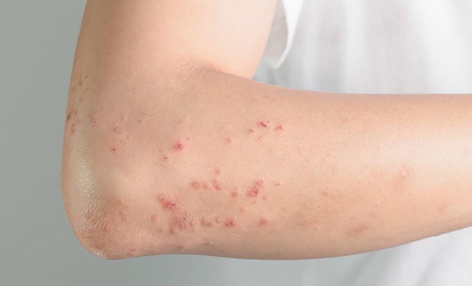  Phản ứng dị ứng trên da do dùng thuốc điều trị lao