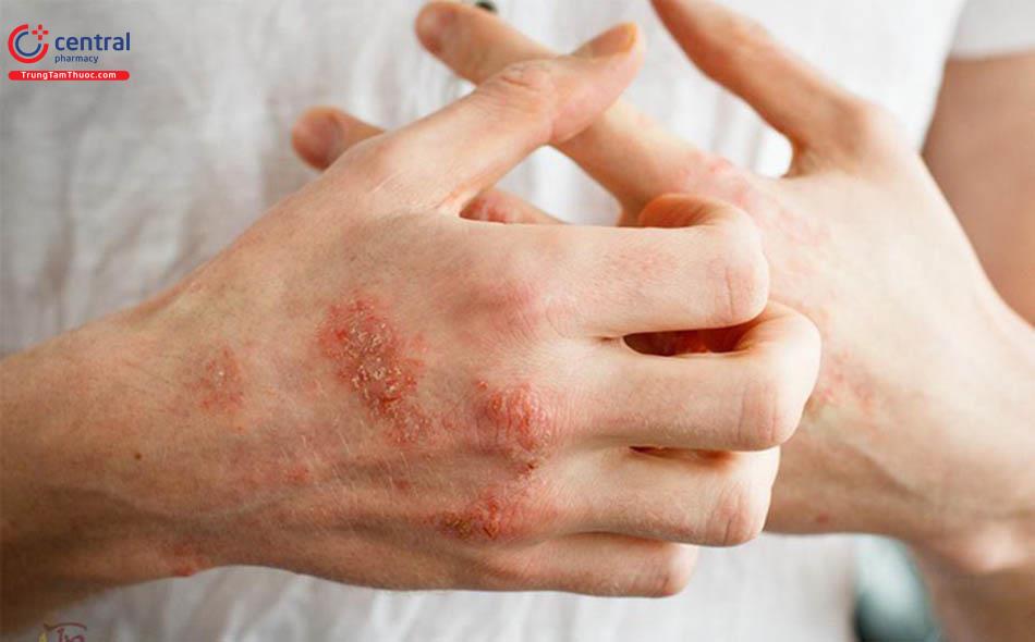 Hình ảnh bệnh ghẻ