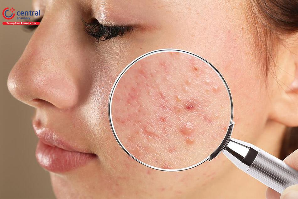 Mụn trứng cá gây ra nhiều phiền toái