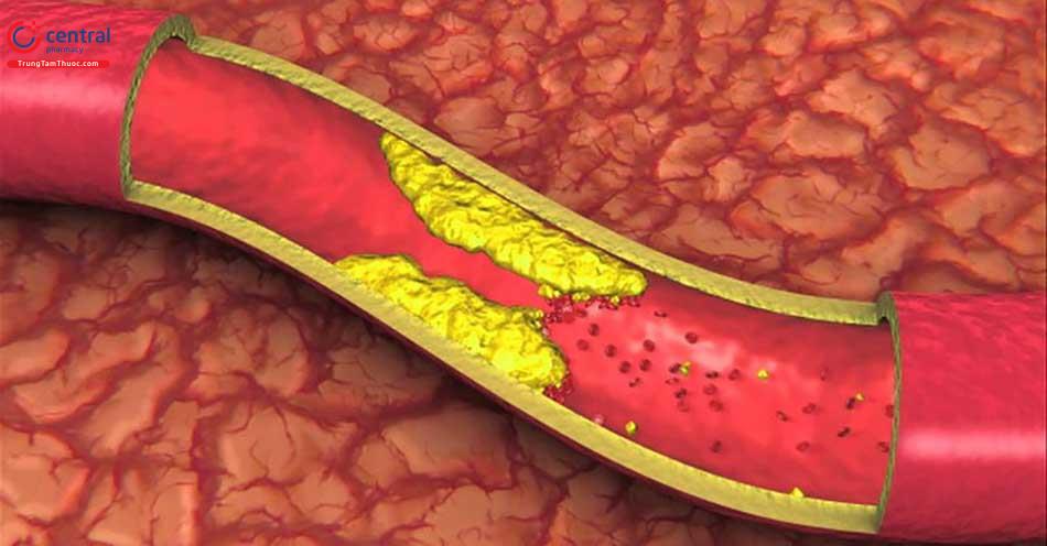 Rối loạn lipid máu