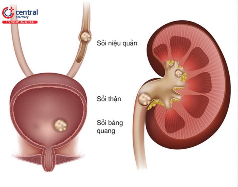 Sỏi tiết niệu