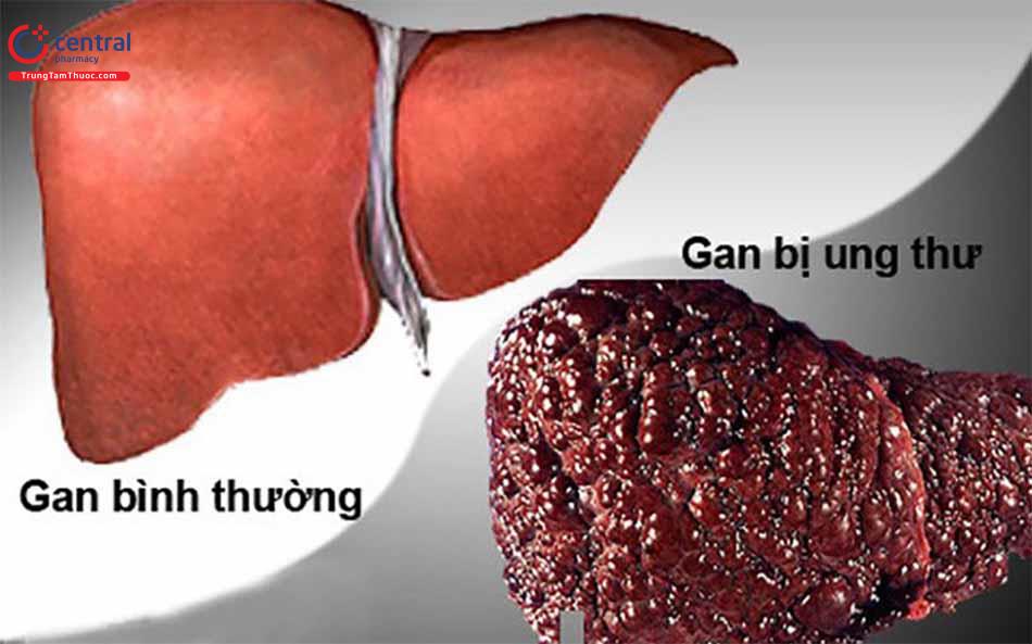 Ung thư gan tiến triển nặng
