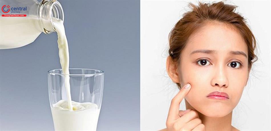 Uống sữa làm trầm trọng hơn tình trạng mụn trứng cá
