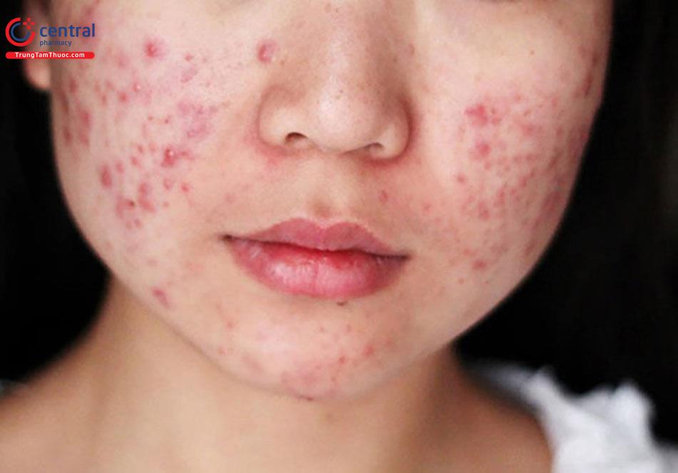 Uống sữa tươi nhiều có thể làm trầm trọng hơn tình trạng mụn trứng cá
