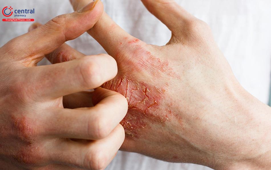 Ảnh minh họa trường hợp viêm da bội nhiễm 