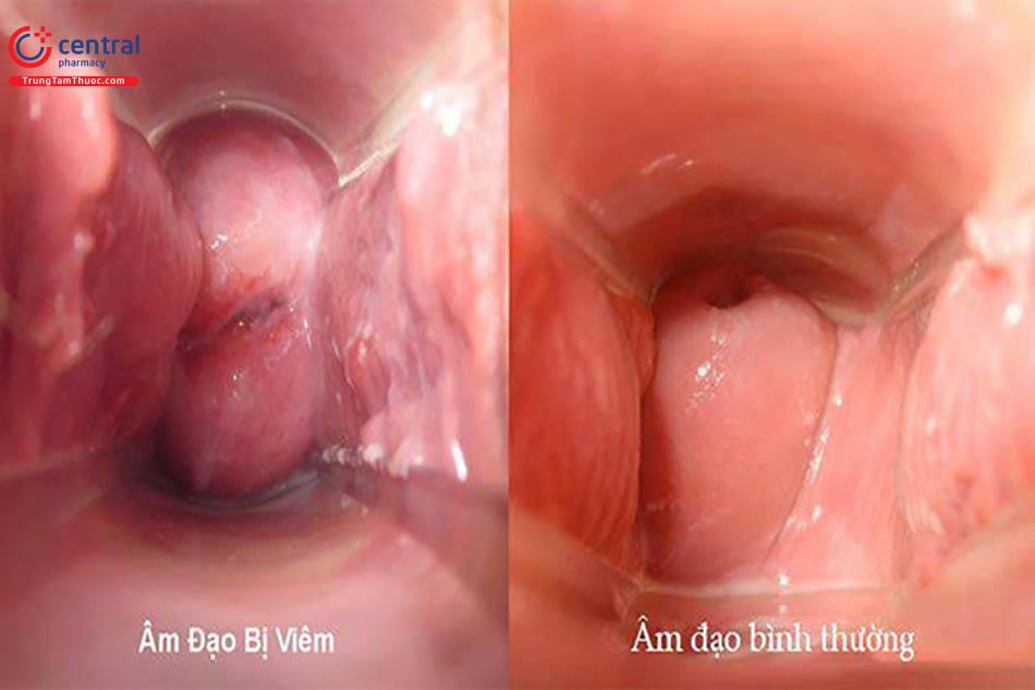 Viêm âm đạo