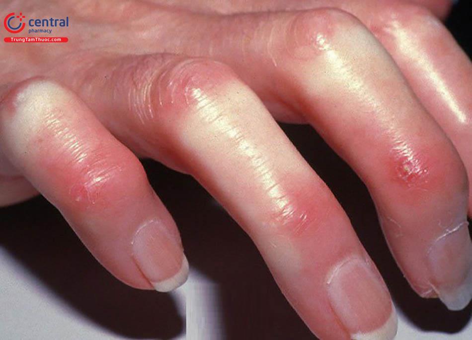 Điều trị Corticoid cho bệnh nhân xơ cứng bì