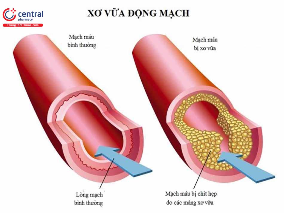 Xơ vữa động mạch khiến một phần tim bị thiếu oxy